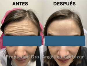 Antes y Después de Botox (toxina botulinica)